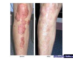 AROGYAM PURE HERBS KIT FOR PSORIASIS